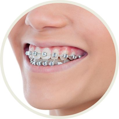 basie joubert like bj braces photo aian tan recommends bj braces pic