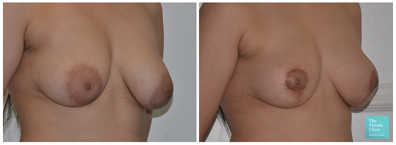 clarissa huges like huge puffy breasts photo andrew kuehl recommends huge puffy breasts pic