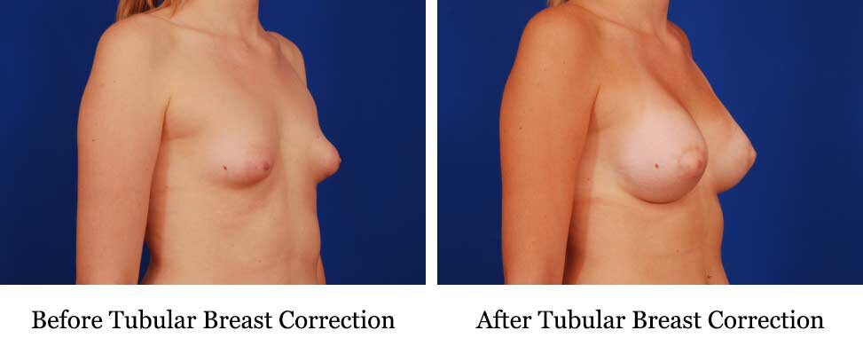 carl pilliner recommends tuber tits pic
