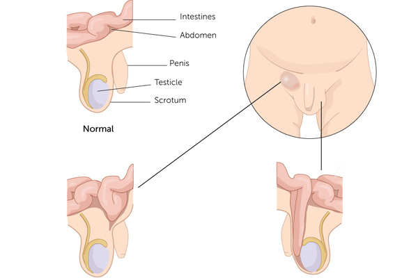 Anal Tummy Bulge a lift