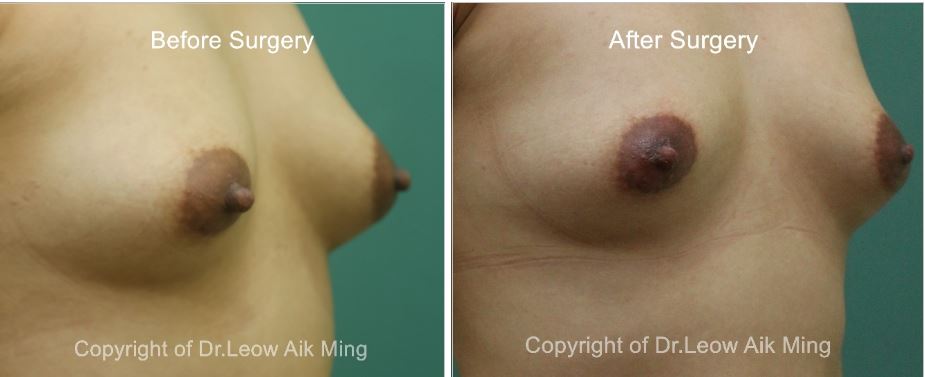adi kaminski recommends areola asian pic