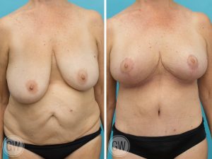 ad ady recommends Small Saggy Mature Tits