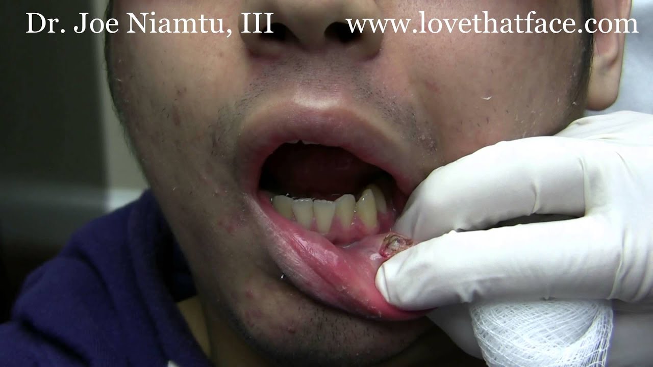 dennis putra recommends how to unscrew a tight piercing ball without gloves cary watkins add how to unscrew a tight piercing ball without gloves photo