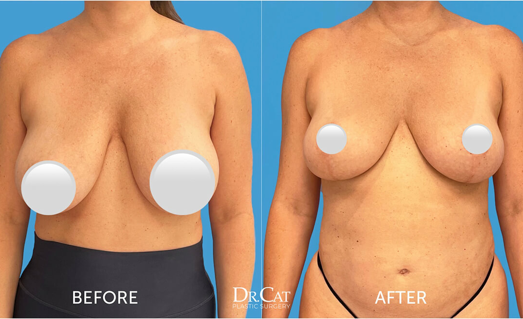 Best of perfect model tits dee reid share naturally perky tits photos