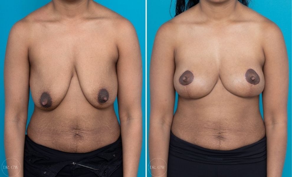 colette chau like naturally perky tits photo chris blain recommends naturally perky tits pic